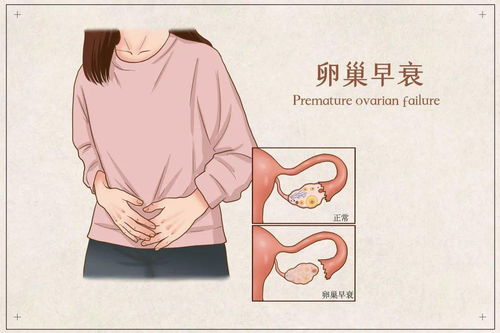 经常情绪暴躁是不是更年期了 六种典型表现别忽略