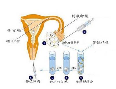 人工授精和试管婴儿有什么区别?