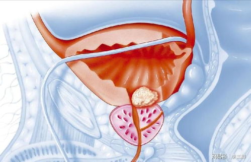 前列腺增生 病因、症状与应对策略
